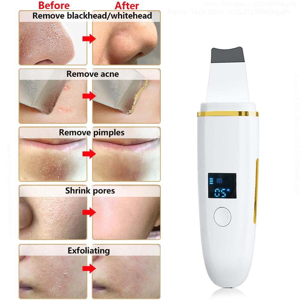 Ultrasonic Skin Scrubber Remover Blackhead Ultrasonic Peeling - Varitique