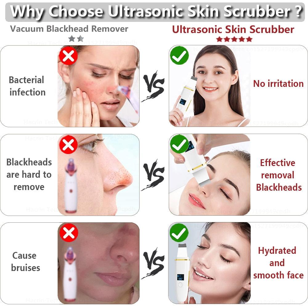 Ultrasonic Skin Scrubber Remover Blackhead Ultrasonic Peeling - Varitique